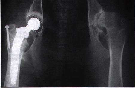 Prot�za ky�eln�ho kloubu na RTG sn�mku